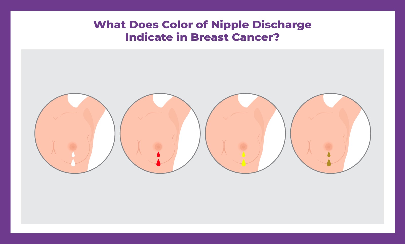 What Does Color Of Nipple Discharge Indicate in Breast Cancer?
