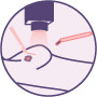 Radio guided Breast Surgery (ROLL)