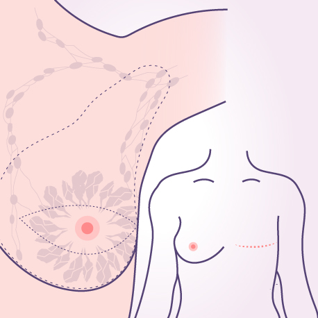 Modified Radical Mastectomy