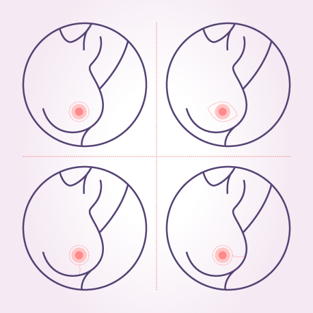 Nipple Sparing Mastectomy